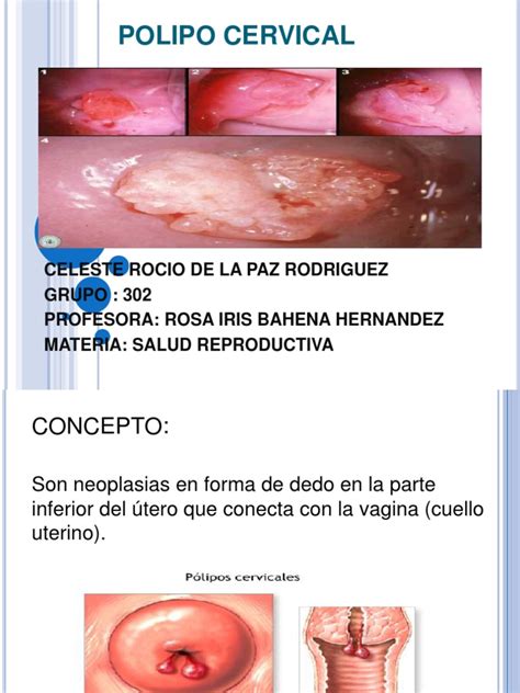 polipo cervical - colete cervical